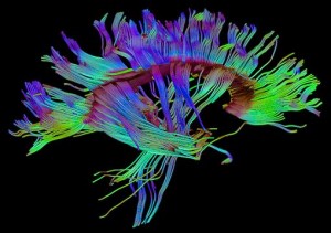 MRI of the brain with DTI analysis